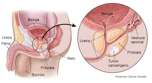 Câncer de próstata

