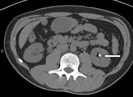 tomografia litíase urinária